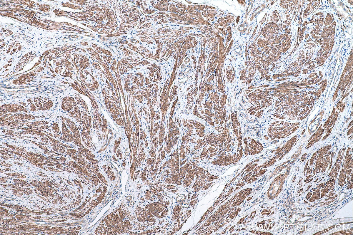 Immunohistochemical analysis of paraffin-embedded human cervical cancer tissue slide using KHC0675 (LPP IHC Kit).