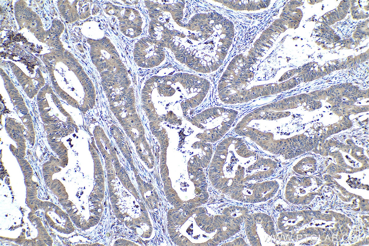 Immunohistochemical analysis of paraffin-embedded human colon cancer tissue slide using KHC0448 (LPPR2 IHC Kit).