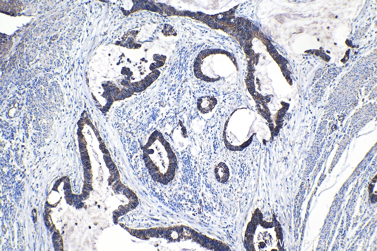 Immunohistochemical analysis of paraffin-embedded human urothelial carcinoma tissue slide using KHC1468 (LPXN IHC Kit).