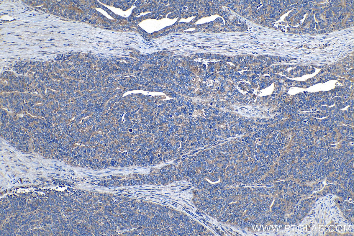 Immunohistochemical analysis of paraffin-embedded human ovary tumor tissue slide using KHC1284 (LRCH1 IHC Kit).