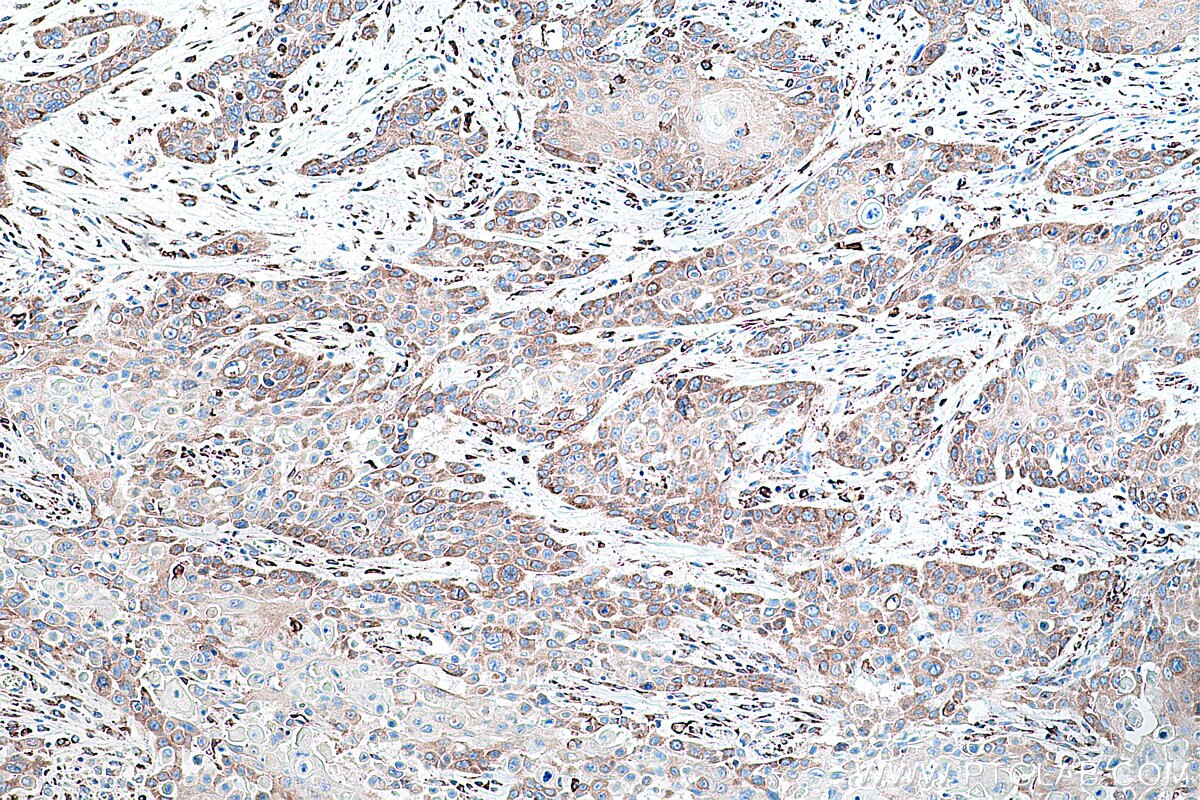 Immunohistochemical analysis of paraffin-embedded human oesophagus cancer tissue slide using KHC0222 (LRPAP1 IHC Kit).