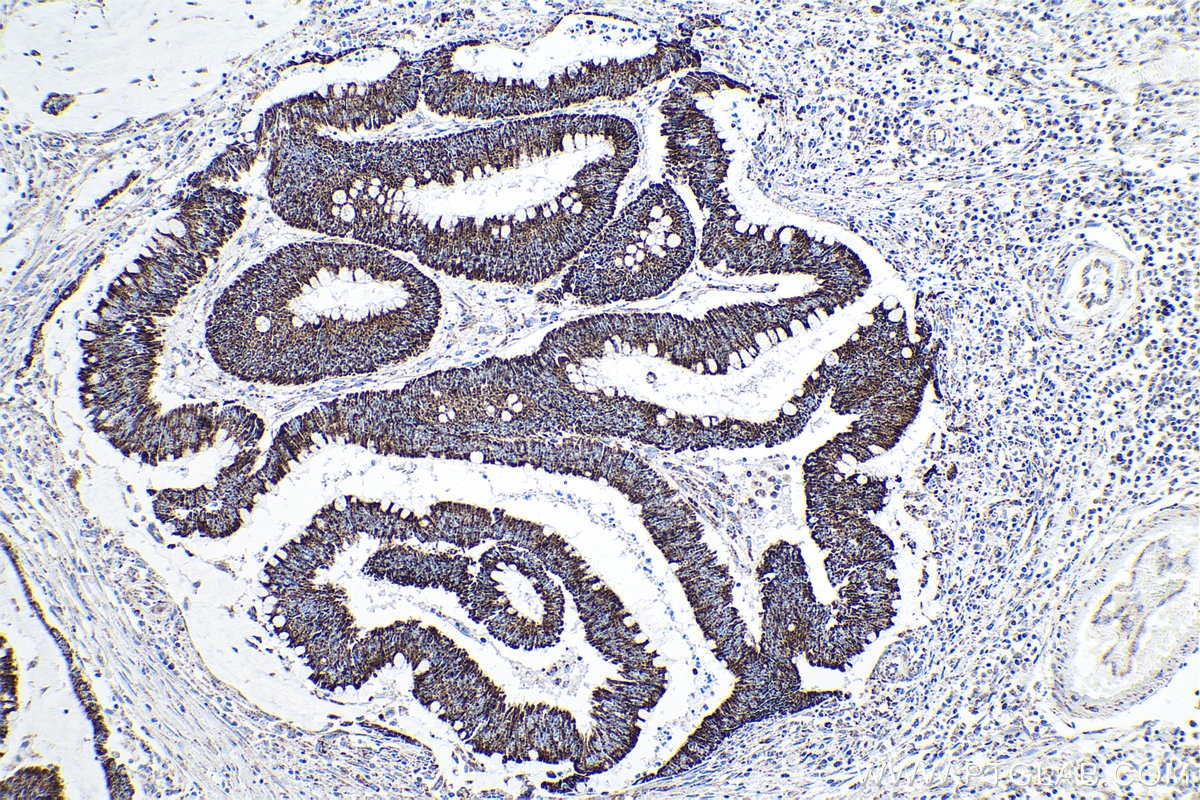 Immunohistochemical analysis of paraffin-embedded human colon cancer tissue slide using KHC0166 (LRPPRC IHC Kit).