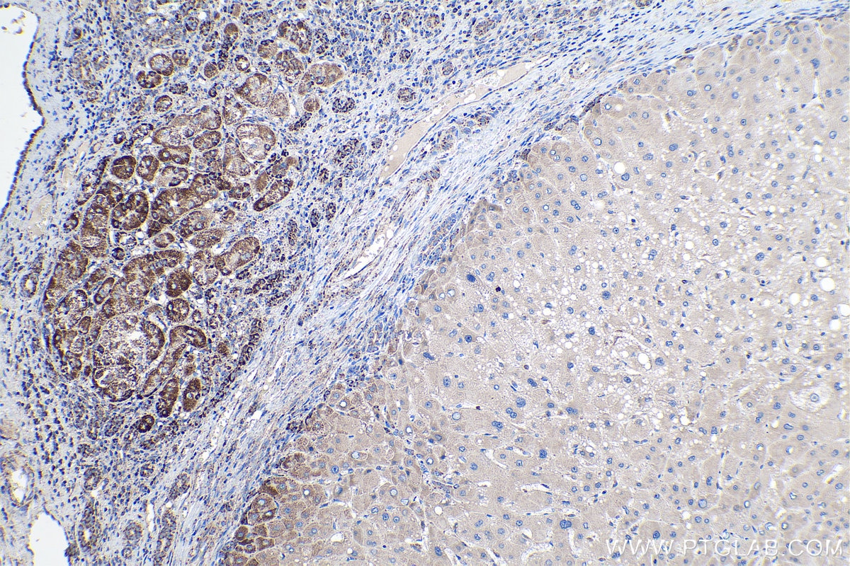 Immunohistochemical analysis of paraffin-embedded human liver cancer tissue slide using KHC0166 (LRPPRC IHC Kit).