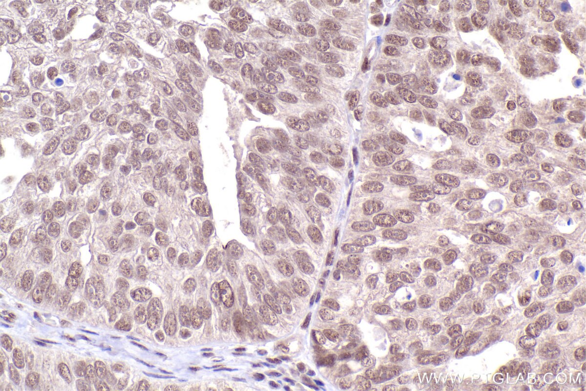 Immunohistochemical analysis of paraffin-embedded human ovary cancer tissue slide using KHC2485 (LRRC41 IHC Kit).