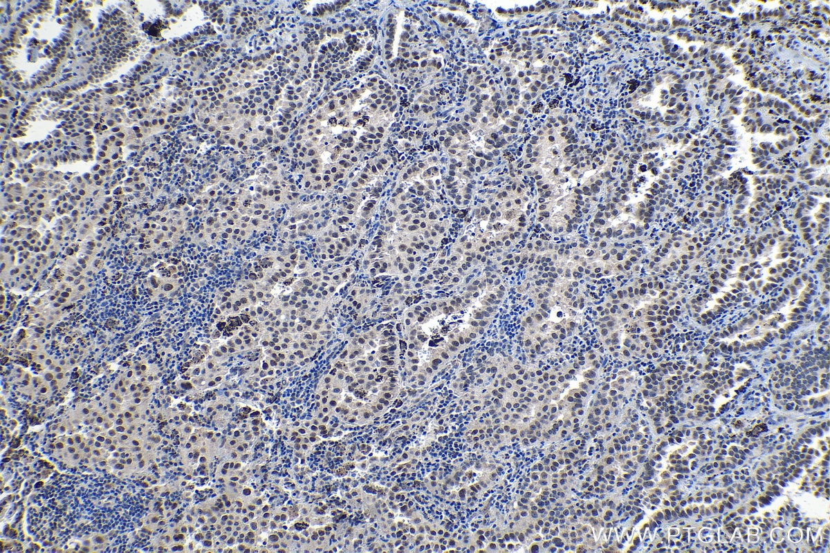 Immunohistochemical analysis of paraffin-embedded human lung cancer tissue slide using KHC1314 (LSM4 IHC Kit).