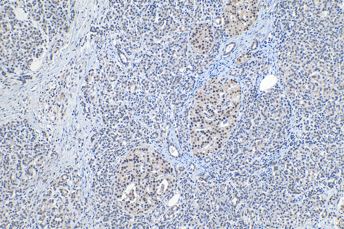 Immunohistochemical analysis of paraffin-embedded human pancreas cancer tissue slide using KHC1314 (LSM4 IHC Kit).