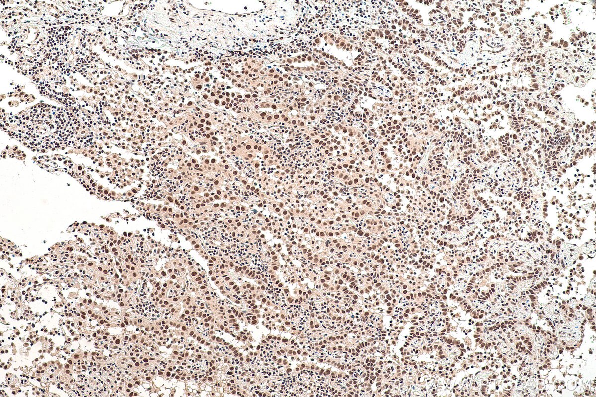 Immunohistochemical analysis of paraffin-embedded human lung cancer tissue slide using KHC0840 (LSM5 IHC Kit).