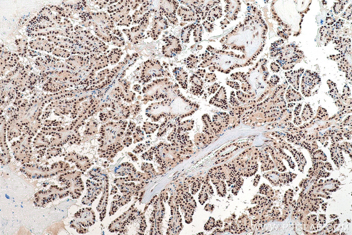 Immunohistochemical analysis of paraffin-embedded human thyroid cancer tissue slide using KHC0840 (LSM5 IHC Kit).