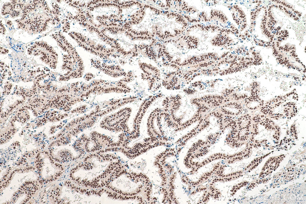 Immunohistochemical analysis of paraffin-embedded human ovary tumor tissue slide using KHC0840 (LSM5 IHC Kit).