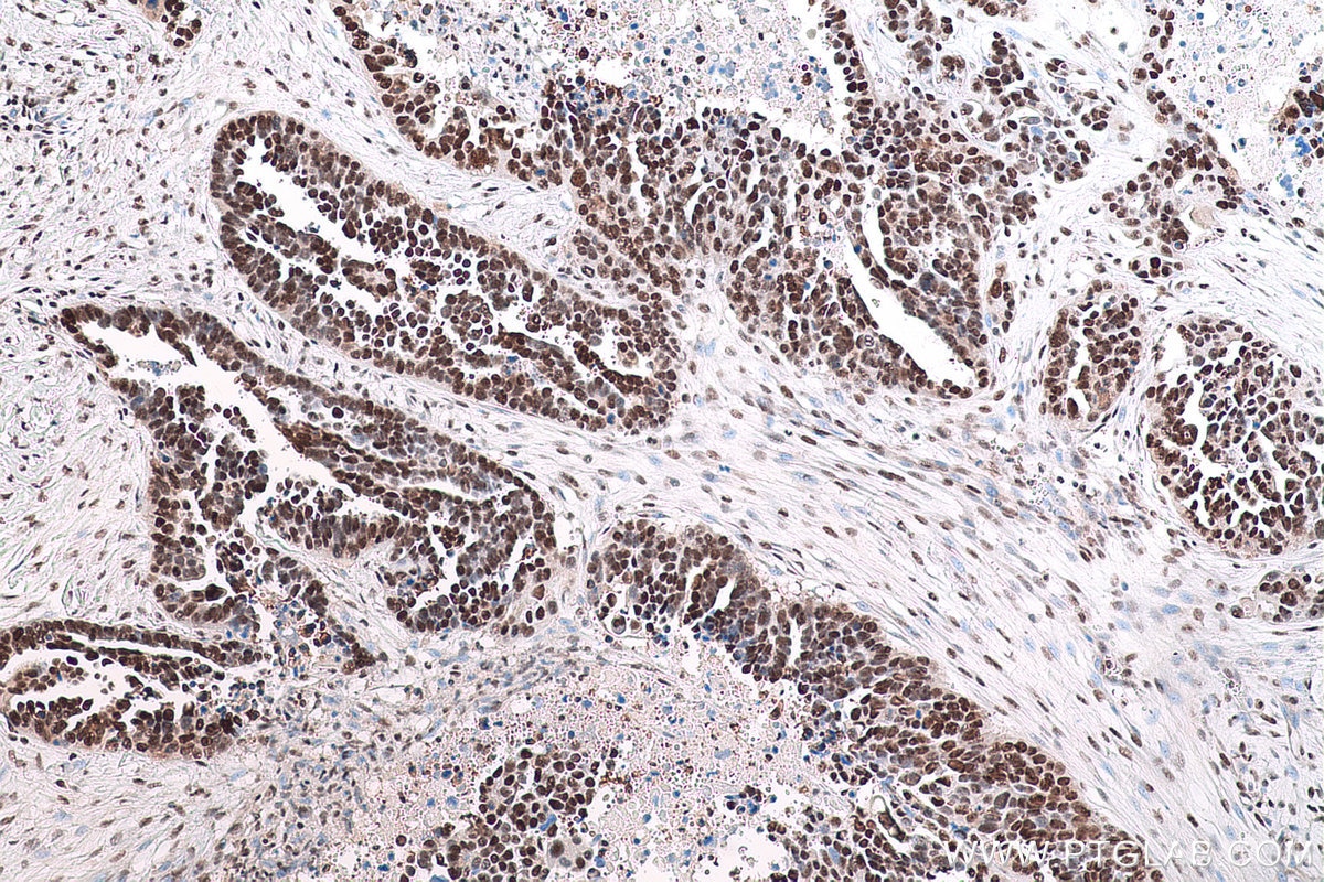 Immunohistochemical analysis of paraffin-embedded human colon cancer tissue slide using KHC0827 (LSM8 IHC Kit).