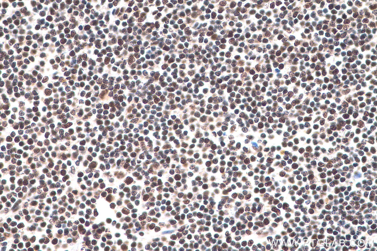 Immunohistochemical analysis of paraffin-embedded human lymphoma tissue slide using KHC0827 (LSM8 IHC Kit).