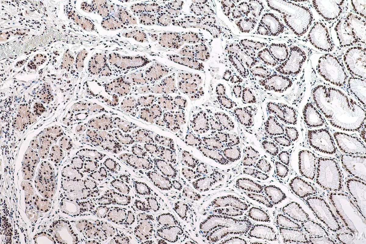 Immunohistochemical analysis of paraffin-embedded human stomach cancer tissue slide using KHC0827 (LSM8 IHC Kit).