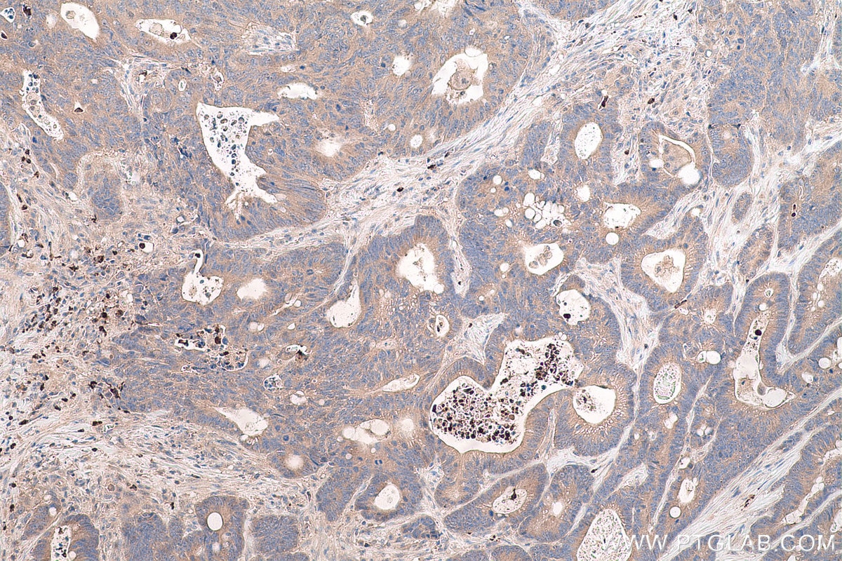 Immunohistochemical analysis of paraffin-embedded human colon cancer tissue slide using KHC0763 (LTF IHC Kit).