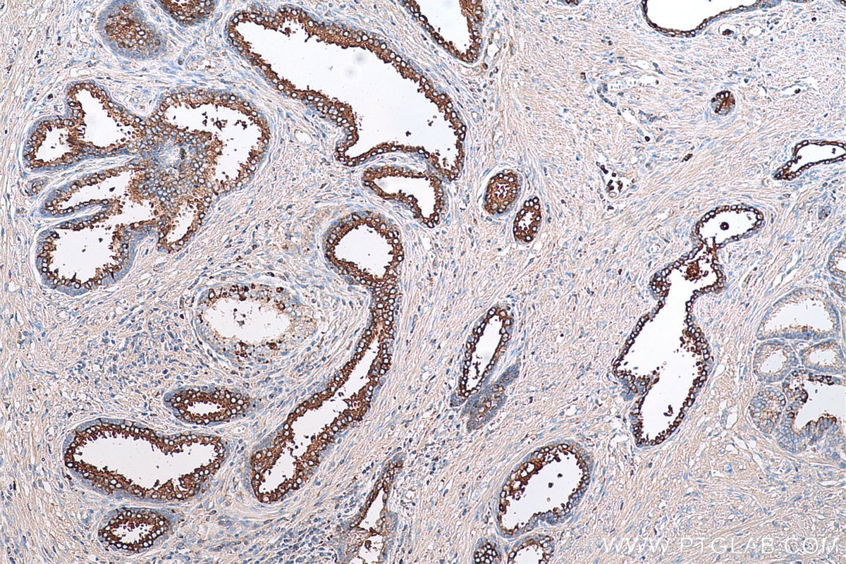 Immunohistochemical analysis of paraffin-embedded human prostate cancer tissue slide using KHC0763 (LTF IHC Kit).