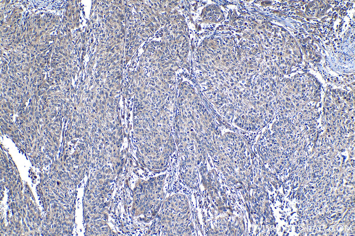 Immunohistochemical analysis of paraffin-embedded human cervical cancer tissue slide using KHC1249 (LUZP1 IHC Kit).