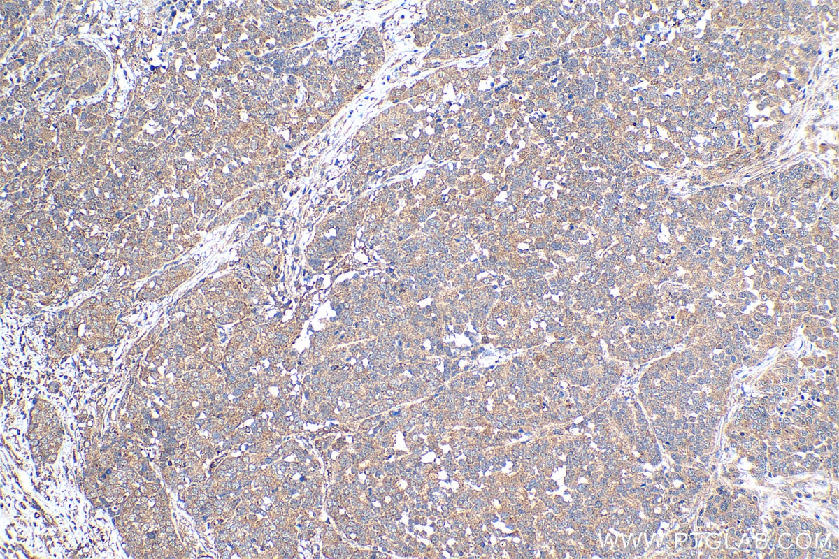Immunohistochemical analysis of paraffin-embedded human ovary tumor tissue slide using KHC1249 (LUZP1 IHC Kit).