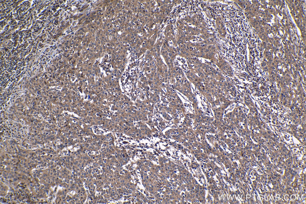 Immunohistochemical analysis of paraffin-embedded human cervical cancer tissue slide using KHC1219 (LYN IHC Kit).