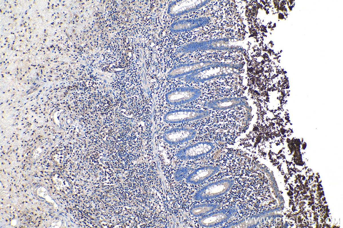 Immunohistochemical analysis of paraffin-embedded human appendicitis tissue slide using KHC1219 (LYN IHC Kit).