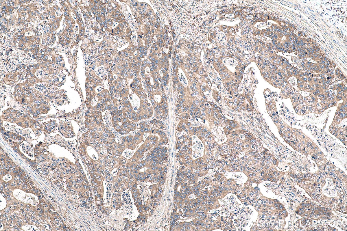 Immunohistochemical analysis of paraffin-embedded human stomach cancer tissue slide using KHC0956 (LZTFL1 IHC Kit).