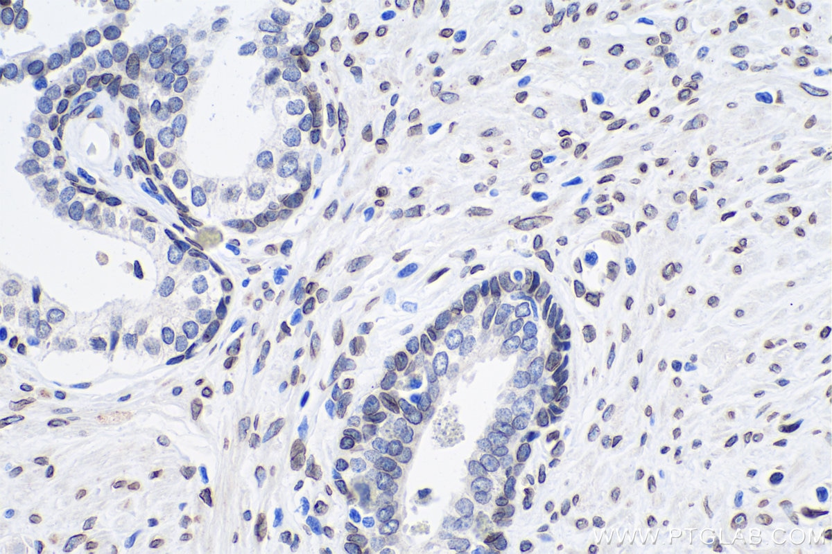 Immunohistochemical analysis of paraffin-embedded human prostate cancer tissue slide using KHC0311 (Lamin A/C IHC Kit).