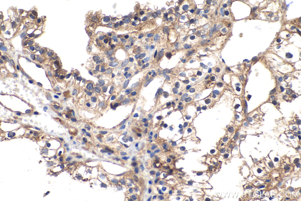 Immunohistochemical analysis of paraffin-embedded human renal cell carcinoma tissue slide using KHC0234 (Leptin IHC Kit).