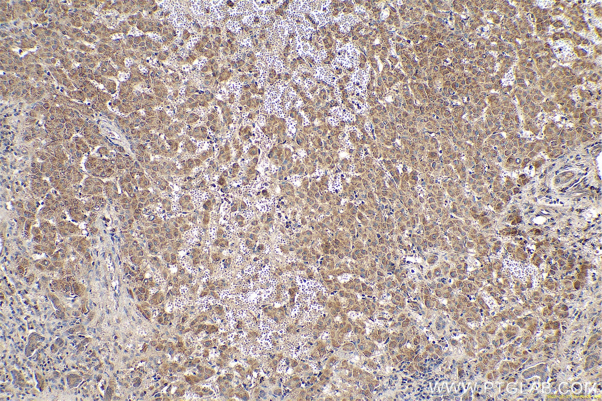 Immunohistochemical analysis of paraffin-embedded human liver cancer tissue slide using KHC0631 (MAD2L1 IHC Kit).