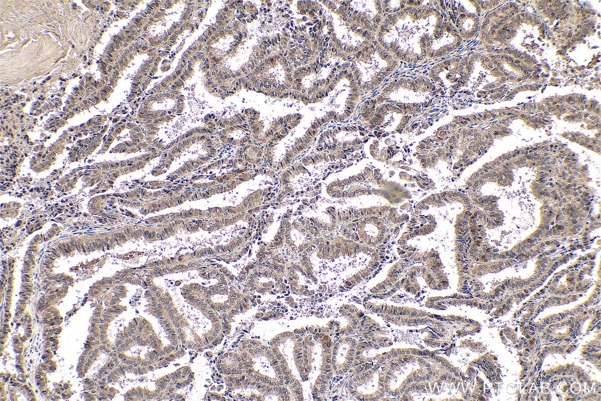 Immunohistochemical analysis of paraffin-embedded human ovary tumor tissue slide using KHC0631 (MAD2L1 IHC Kit).