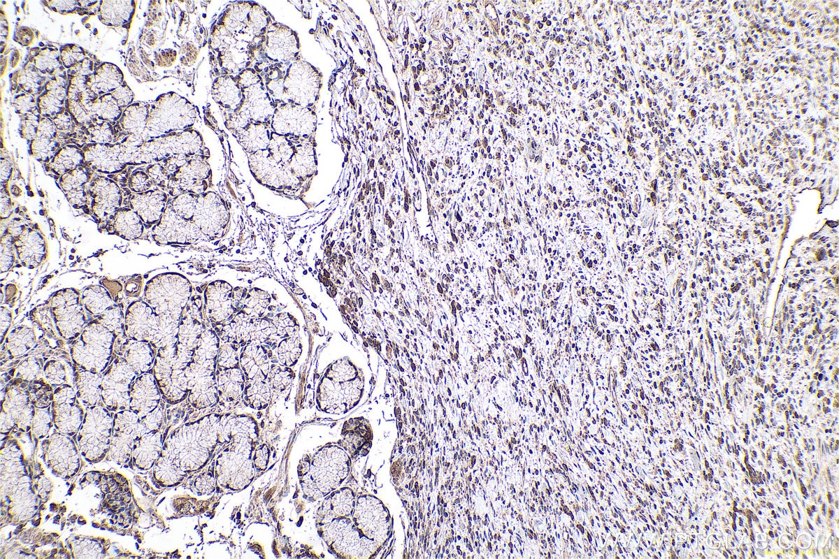 Immunohistochemical analysis of paraffin-embedded human stomach cancer tissue slide using KHC0631 (MAD2L1 IHC Kit).