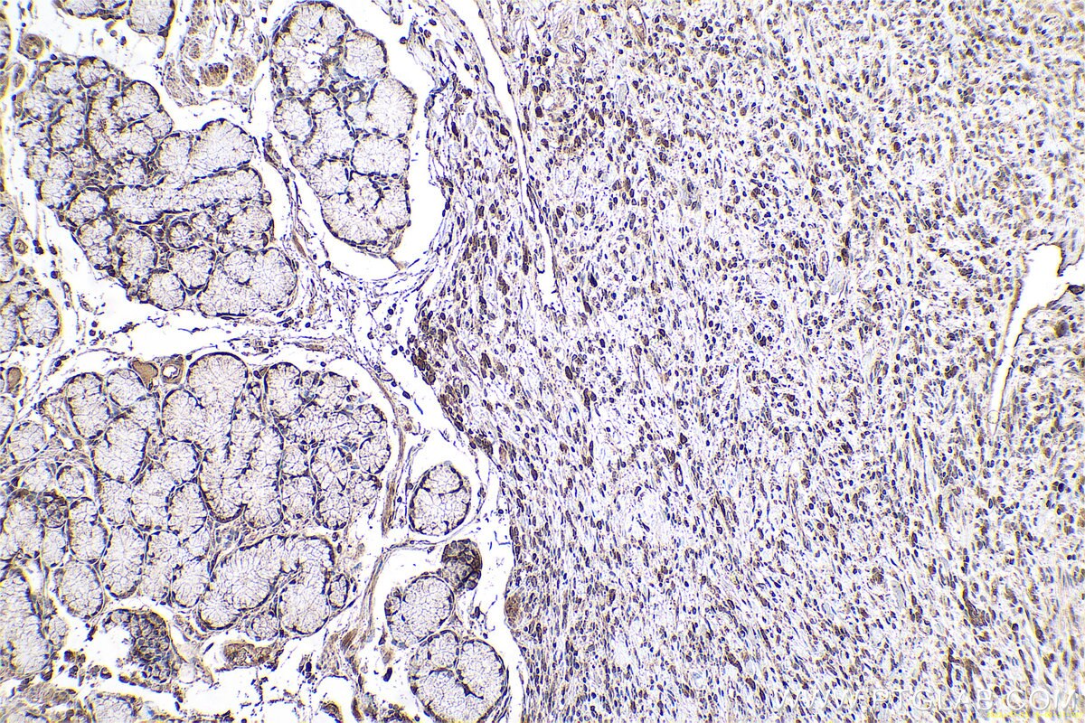 Immunohistochemical analysis of paraffin-embedded human stomach cancer tissue slide using KHC0631 (MAD2L1 IHC Kit).