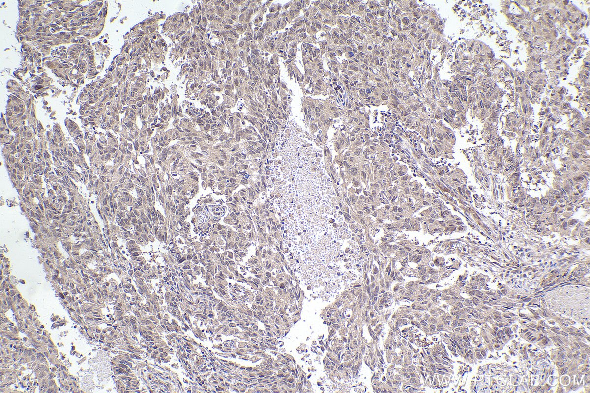Immunohistochemical analysis of paraffin-embedded human lung cancer tissue slide using KHC2476 (MAD2L1BP IHC Kit).