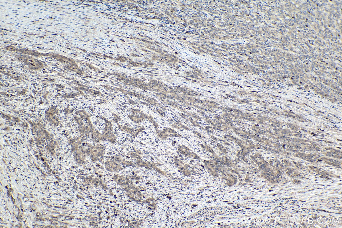 Immunohistochemical analysis of paraffin-embedded human stomach cancer tissue slide using KHC1798 (MAEA IHC Kit).