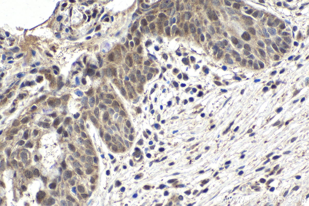 Immunohistochemical analysis of paraffin-embedded human cervical cancer tissue slide using KHC1798 (MAEA IHC Kit).