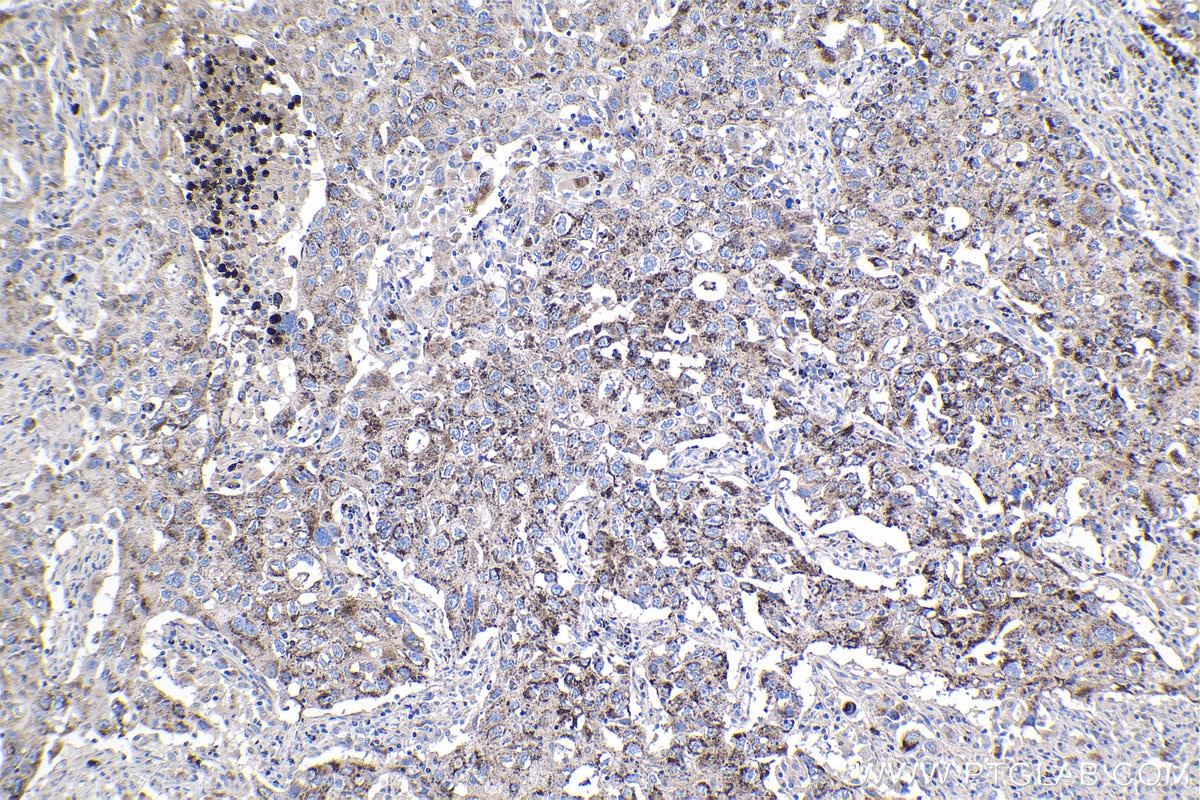 Immunohistochemical analysis of paraffin-embedded human lung cancer tissue slide using KHC1075 (MAGEA3 IHC Kit).