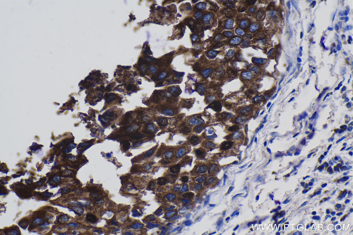 Immunohistochemical analysis of paraffin-embedded human breast cancer tissue slide using KHC1075 (MAGEA3 IHC Kit).