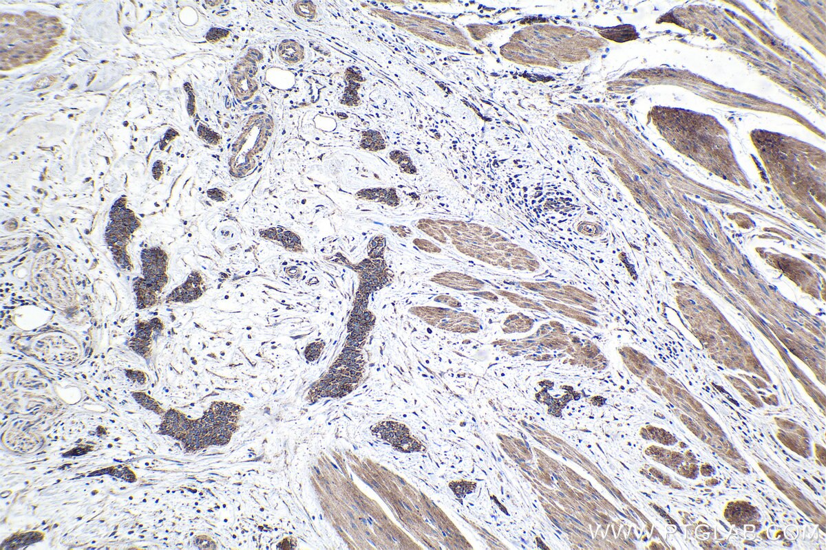 Immunohistochemical analysis of paraffin-embedded human urothelial carcinoma tissue slide using KHC1075 (MAGEA3 IHC Kit).