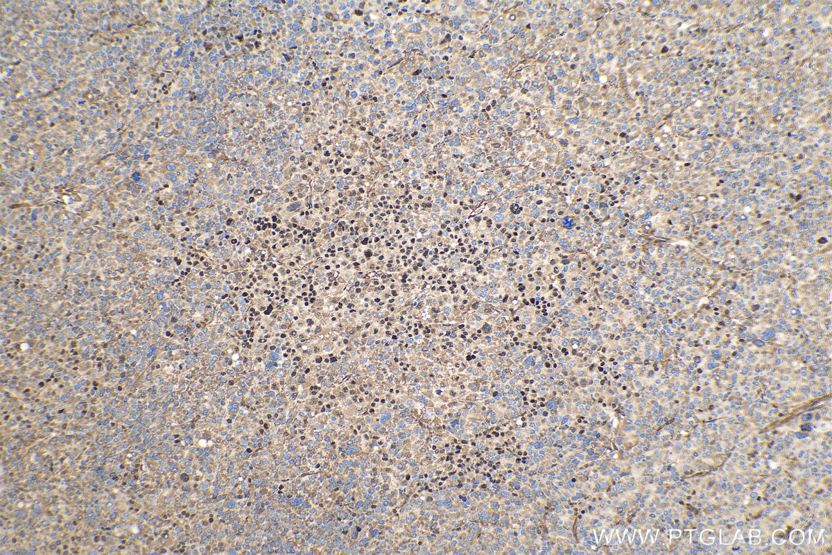 Immunohistochemical analysis of paraffin-embedded human liver cancer tissue slide using KHC0272 (MAGEC2 IHC Kit).