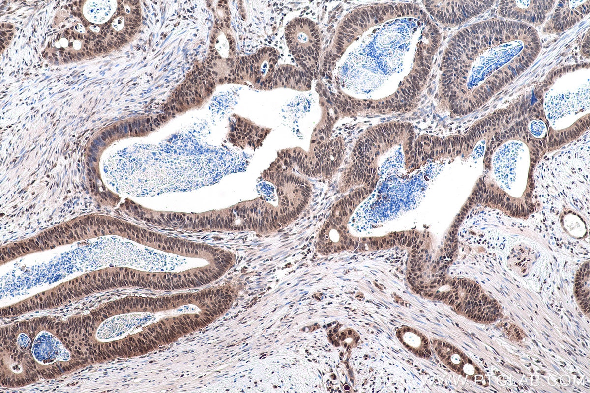 Immunohistochemical analysis of paraffin-embedded human colon cancer tissue slide using KHC0856 (MAGOH IHC Kit).