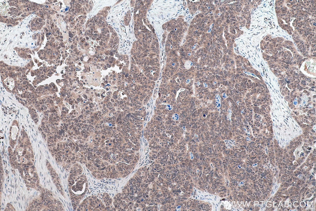 Immunohistochemical analysis of paraffin-embedded human ovary tumor tissue slide using KHC0856 (MAGOH IHC Kit).