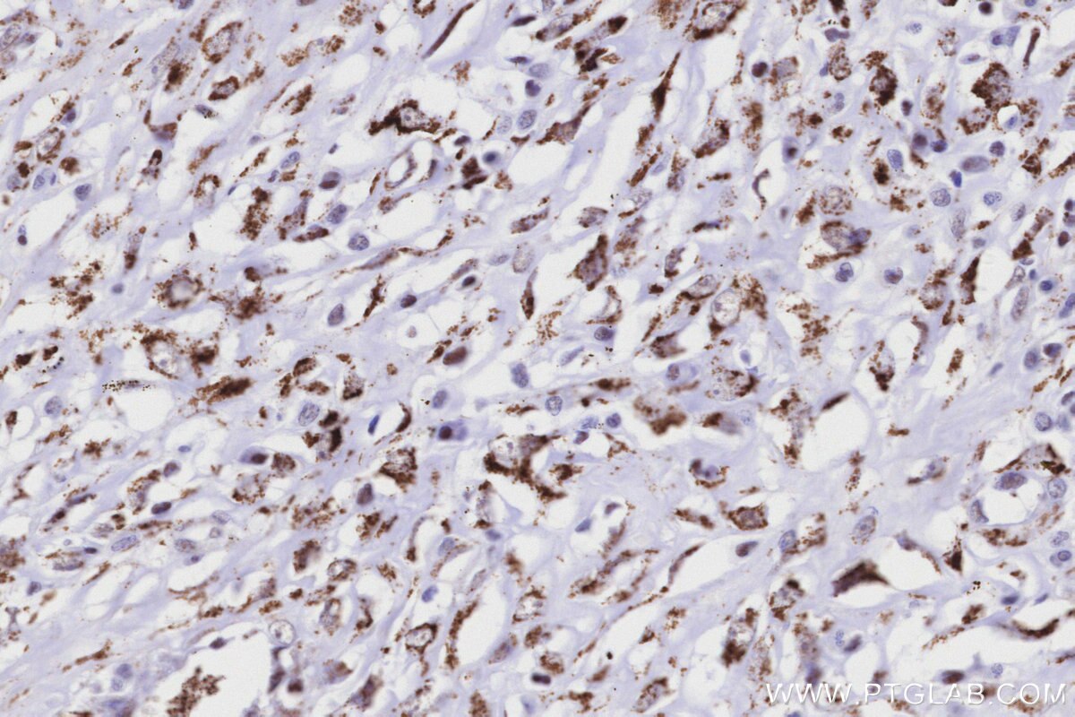 Immunohistochemical analysis of paraffin-embedded human colon cancer tissue slide using KHC3204 (MAOB IHC Kit). Immunohistochemical analysis of paraffin-embedded human colon cancer tissue slide using KHC3204 (MAOB IHC Kit).