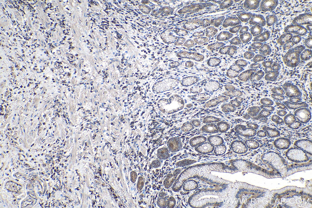 Immunohistochemical analysis of paraffin-embedded human stomach cancer tissue slide using KHC0986 (MAP2K2 IHC Kit).