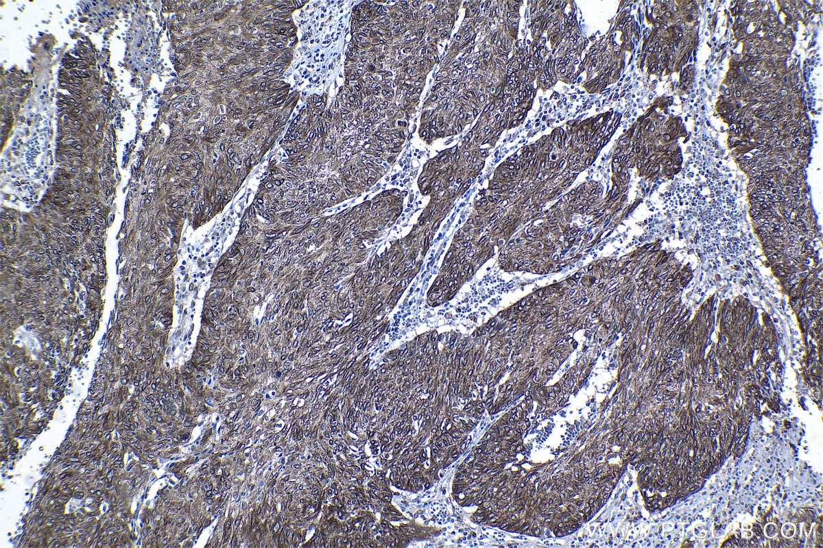 Immunohistochemical analysis of paraffin-embedded human cervical cancer tissue slide using KHC1236 (MAP7 IHC Kit).