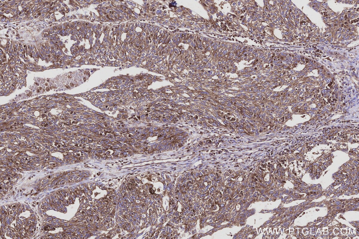Immunohistochemical analysis of paraffin-embedded human ovary cancer tissue slide using KHC3102 (MAP7D1 IHC Kit). Immunohistochemical analysis of paraffin-embedded human ovary cancer tissue slide using KHC3102 (MAP7D1 IHC Kit).