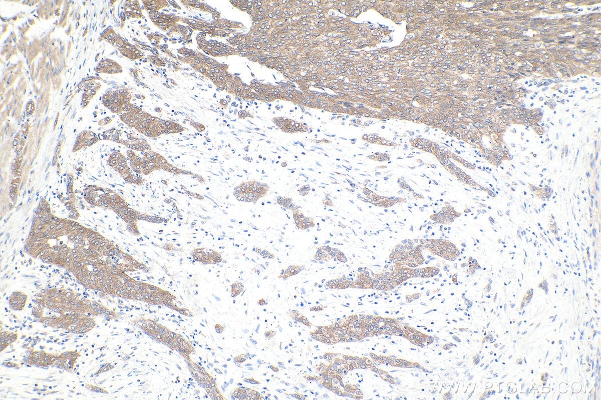 Immunohistochemical analysis of paraffin-embedded human urothelial carcinoma tissue slide using KHC1626 (MAPK10 IHC Kit).