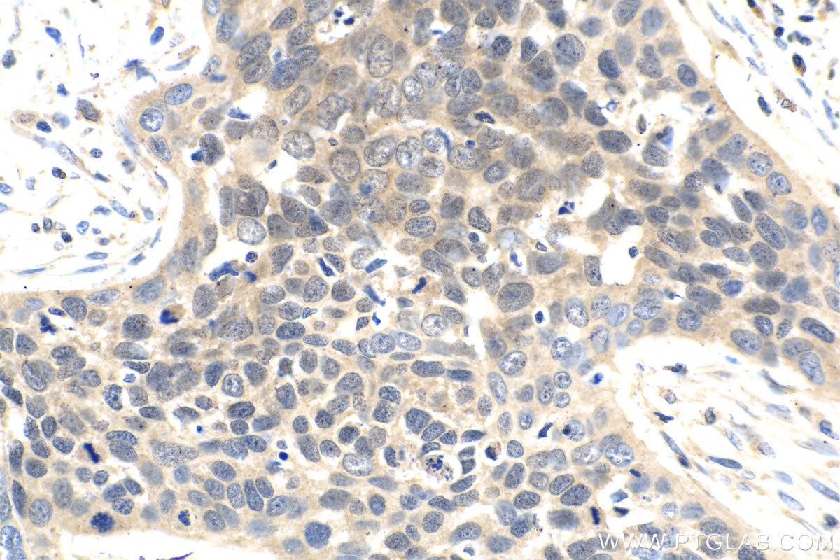 Immunohistochemical analysis of paraffin-embedded human oesophagus cancer tissue slide using KHC2069 (MAPK13 IHC Kit).
