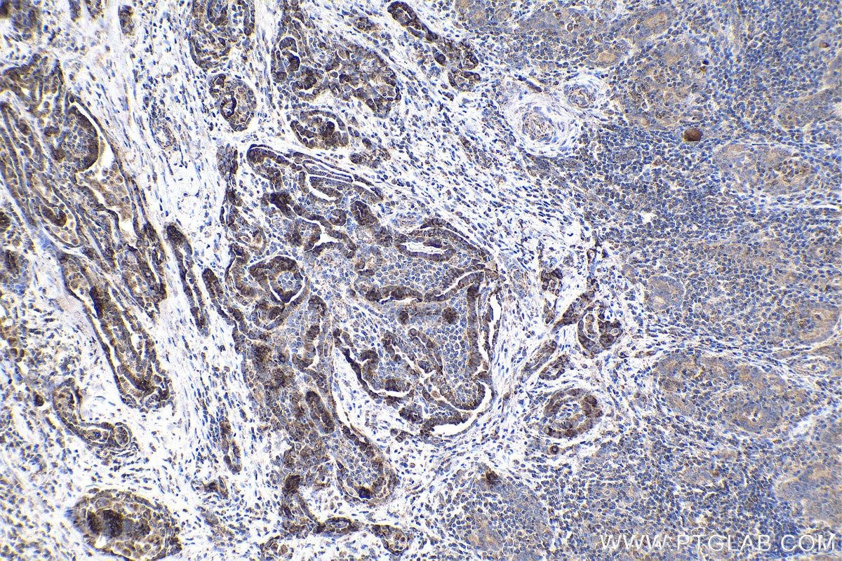Immunohistochemical analysis of paraffin-embedded human thyroid cancer tissue slide using KHC1704 (MAPK7 IHC Kit).