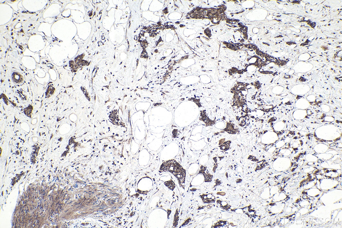 Immunohistochemical analysis of paraffin-embedded human urothelial carcinoma tissue slide using KHC1704 (MAPK7 IHC Kit).