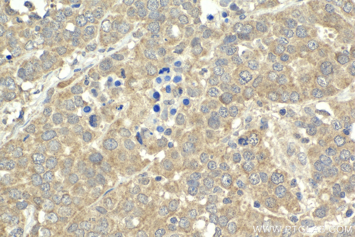 Immunohistochemical analysis of paraffin-embedded human ovary tumor tissue slide using KHC2010 (MAPK8IP1/JIP1 IHC Kit).