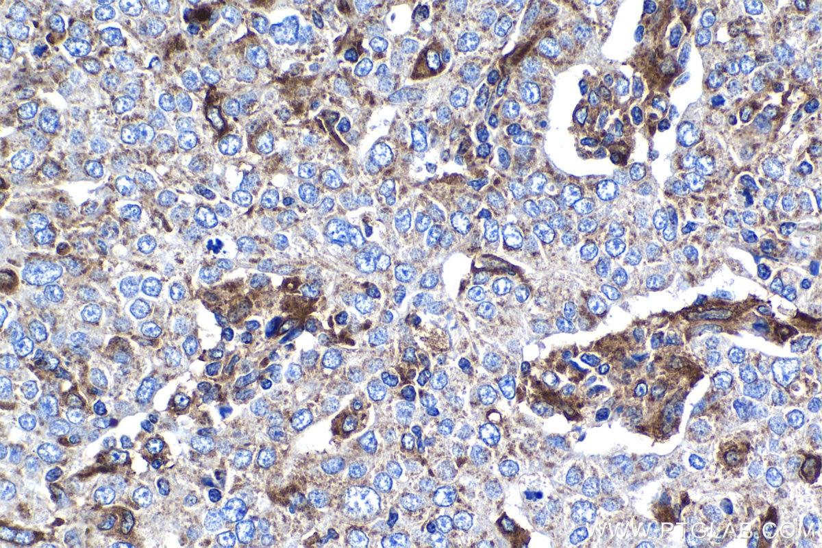 Immunohistochemical analysis of paraffin-embedded human ovary tumor tissue slide using KHC1287 (MAPKBP1 IHC Kit).