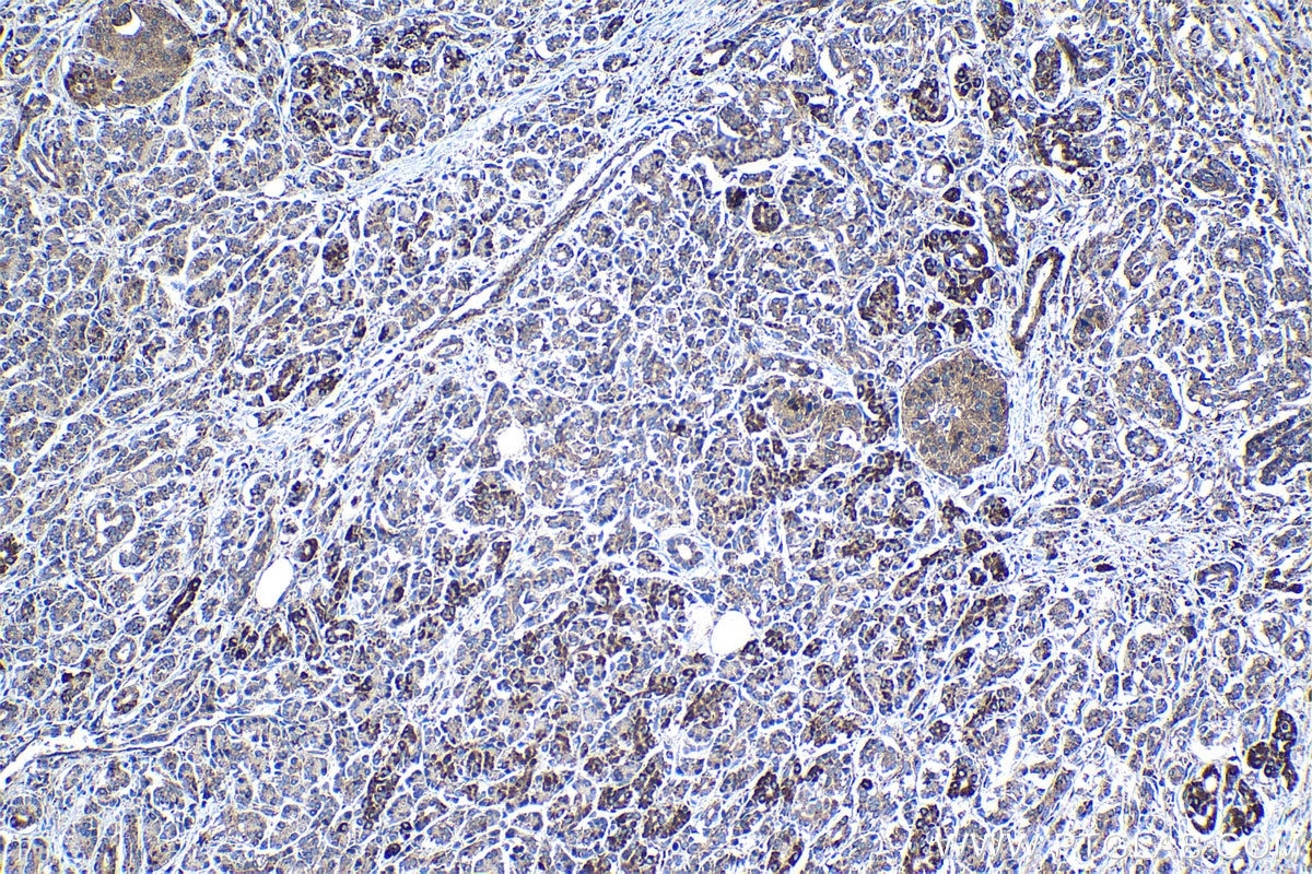 Immunohistochemical analysis of paraffin-embedded human pancreas cancer tissue slide using KHC1287 (MAPKBP1 IHC Kit).