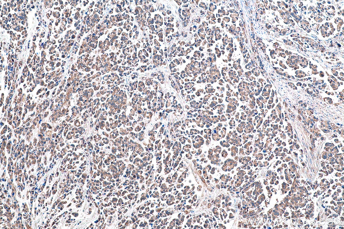 Immunohistochemical analysis of paraffin-embedded human colon cancer tissue slide using KHC0948 (MARCKSL1 IHC Kit).